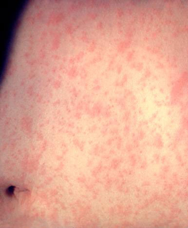 DPH confirms three new measles cases in Georgia